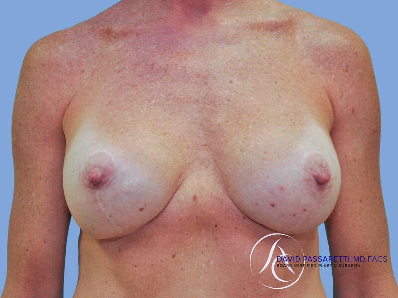 Breast lift before & after photo